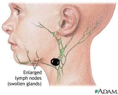 swollen lymph node under chin